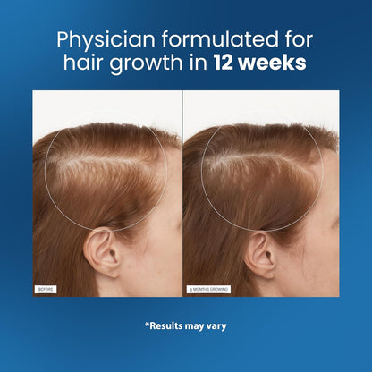Be Bodywise Rosemary Hair Growth Serum Roll On 25 ml – 3% Rosemary, 3% Redensyl & 2% Anagain | DHT-Blocking Scalp Serum Boosts Oxygen Flow, Reduces Hair Fall | Paraben/Sulfate-Free | Women & Men